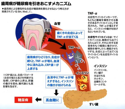 歯周病と全身疾患 | さかの歯科歯周病専門サイト