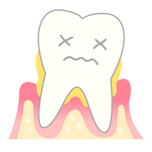 歯周病の定義1