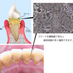 歯周病原因4