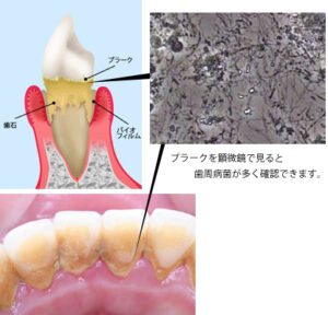 歯周病原因4