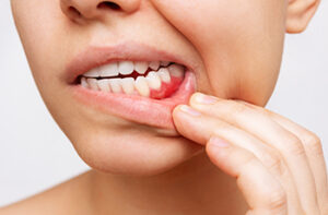 健康歯周病2