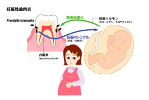 妊娠性歯周炎２