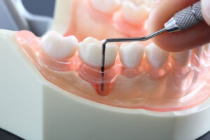 歯周病の治療3